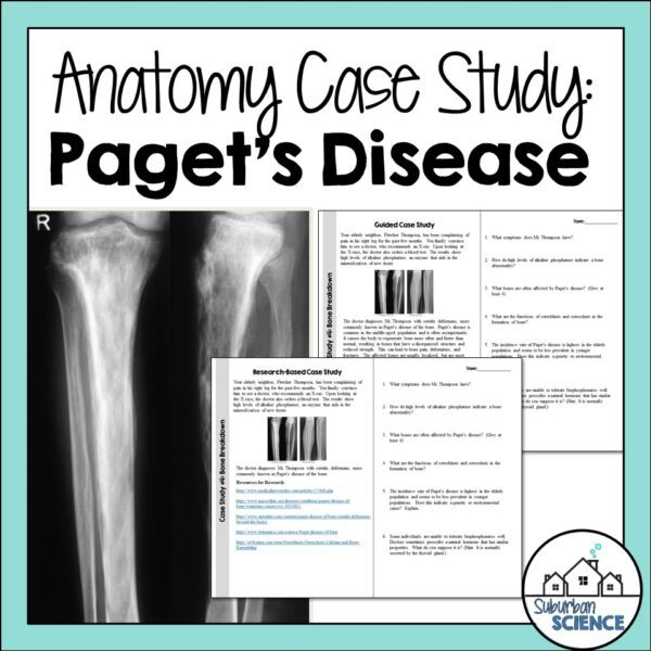 Case Study Anatomy and Physiology - Paget's Disease